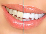 Bělení zubů: doma nebo v ordinaci?