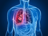 CHOPN vzniká v mládí, často předchází rakovině plic