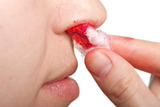 Krvácení z nosu - příčiny a první pomoc