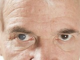 Šedý zákal - nejčastější mýty a omyly o tomto očním onemocnění
