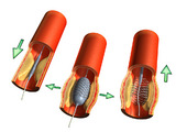 Perkutální transluminální angioplastika