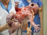 Klešťový porod a porod vakuumextrakcí