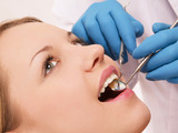 Vytržení zubu (extrakce). Co dělat a nedělat po chirurgickém zákroku v ústech?