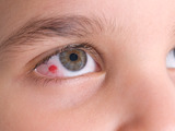 I drobné poranění oka může způsobit vážné komplikace