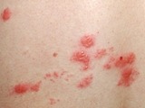 Pásový opar: virus planých neštovic dokáže bolestivě potrápit i dospělé