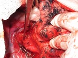 Unikátní operace Na Bulovce: nádor rozpustilo elektrické pole 