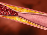 Ateroskleróza - nemoc (nejen) z blahobytu