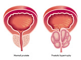 Prostata - Zbytnění prostaty
