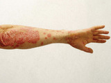 Lupénka - onemocnění kůže, které staví postižené na okraj společnosti