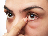 Syndrom suchého oka - nepleťte si ho s alergií