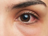 Červené oči - únava, ale i závažné onemocnění
