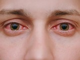 Zarudnutí očí aneb co dělat, když oko zrudne?