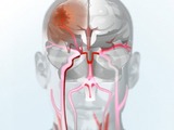 Nové možnosti léčby cévní mozkové příhody i fibrilace síní