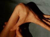 Marfanův syndrom: nemoc pavoučích prstů