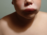 Hereditární angioedém: bolestivé otoky, které jsou často zaměňovány za alergii