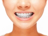 Zuby lze srovnat v každém věku. Dospělí si ale za rovnátka připlatí.