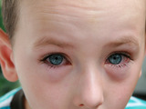 První pomoc při poranění oka u dětí