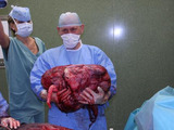 Unikátní operace: Lékaři KNTB odstranili ženě šestatřicetikilový zhoubný nádor