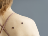 Kontrola znamének: Kdy je potřeba navštívit dermatologa?