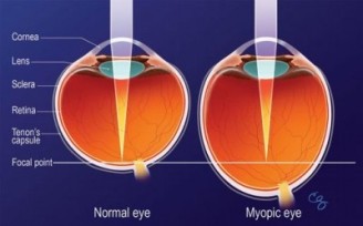 myopické oko