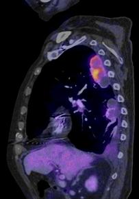Snímek pozitronové emisní tomografie