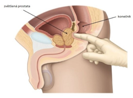 vyšetření prostaty