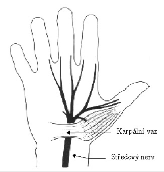Syndrom karpálního tunelu Syndrom karpálního tunelu