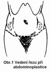 Abdominoplastika (plastika stěny břišní) Abdominoplastika (plastika stěny břišní)