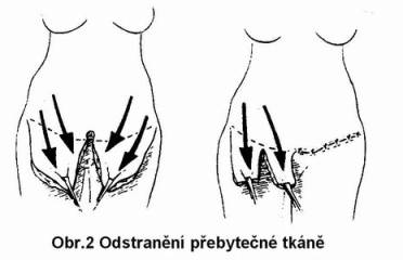 Abdominoplastika  (plastika stěny břišní)