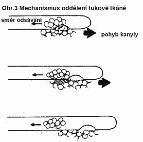 Liposukce