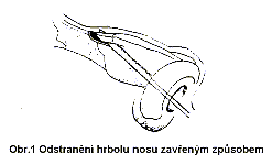 Operace nosu (rhinoplastika) Operace nosu (rhinoplastika)