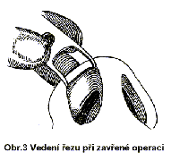 Operace nosu (rhinoplastika) Operace nosu (rhinoplastika)