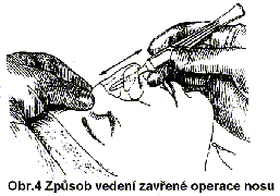 Operace nosu (rhinoplastika)