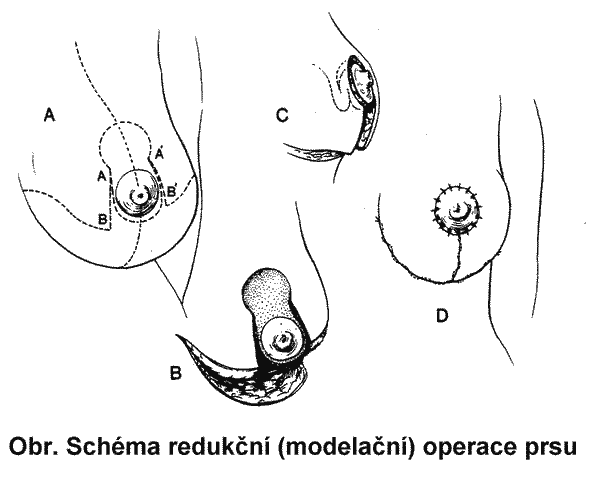 redukční operace prsu