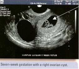 Těhotenství a ultrazvuk I