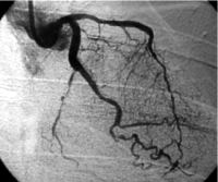 Perkutální transluminální angioplastika