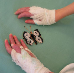 Epidermolysis bullosa Epidermolysis bullosa
