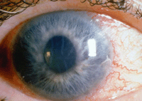 Akutní glaukom