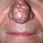  rhinophyma