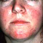 rosacea