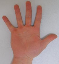 Syndrom karpálního tunelu Syndrom karpálního tunelu