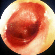 otitis media – zánět středního ucha